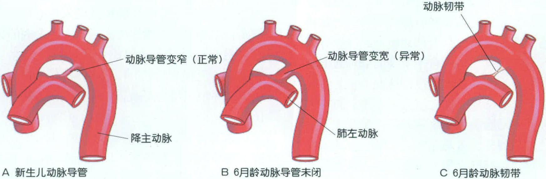 血管變異和畸形